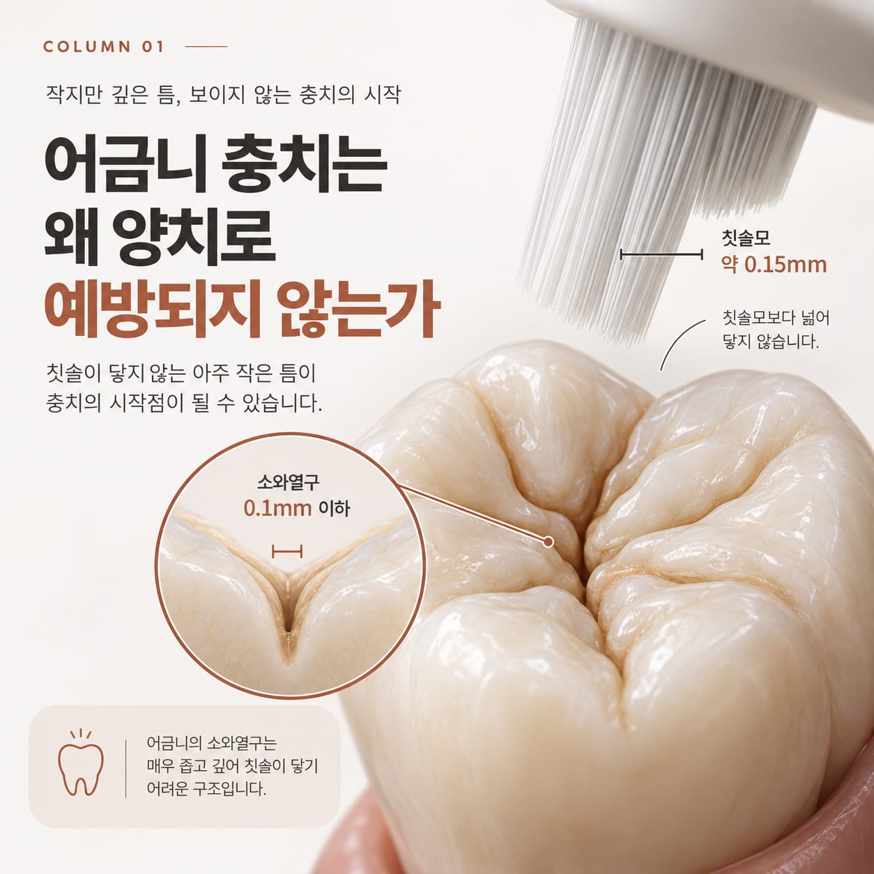 어금니 교합면의 소와열구 폭 0.1mm 이하와 칫솔모 굵기 0.15mm를 비교한 그림