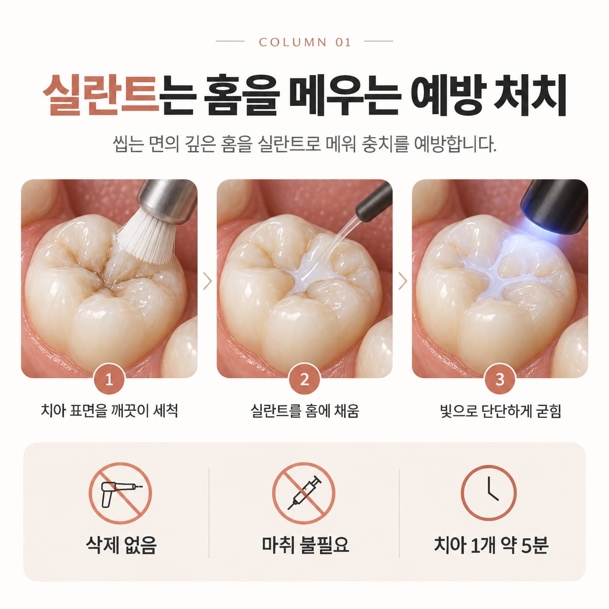 실란트 시술 3단계 — 치아 표면 세척, 홈에 전색재 채움, 광중합으로 경화