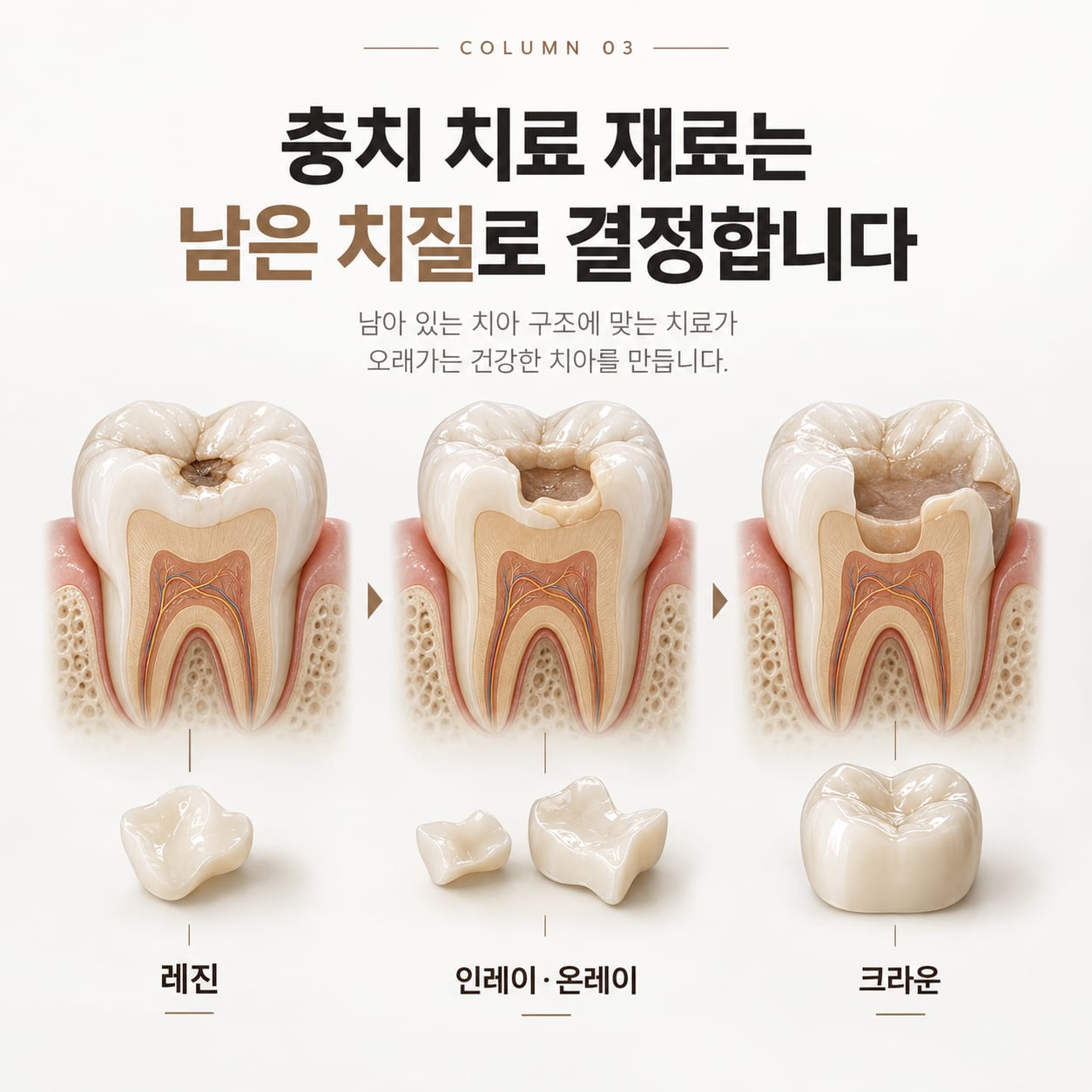 와동 범위에 따라 레진, 인레이·온레이, 크라운으로 나뉘는 수복 방식을 치아 단면으로 비교한 그림