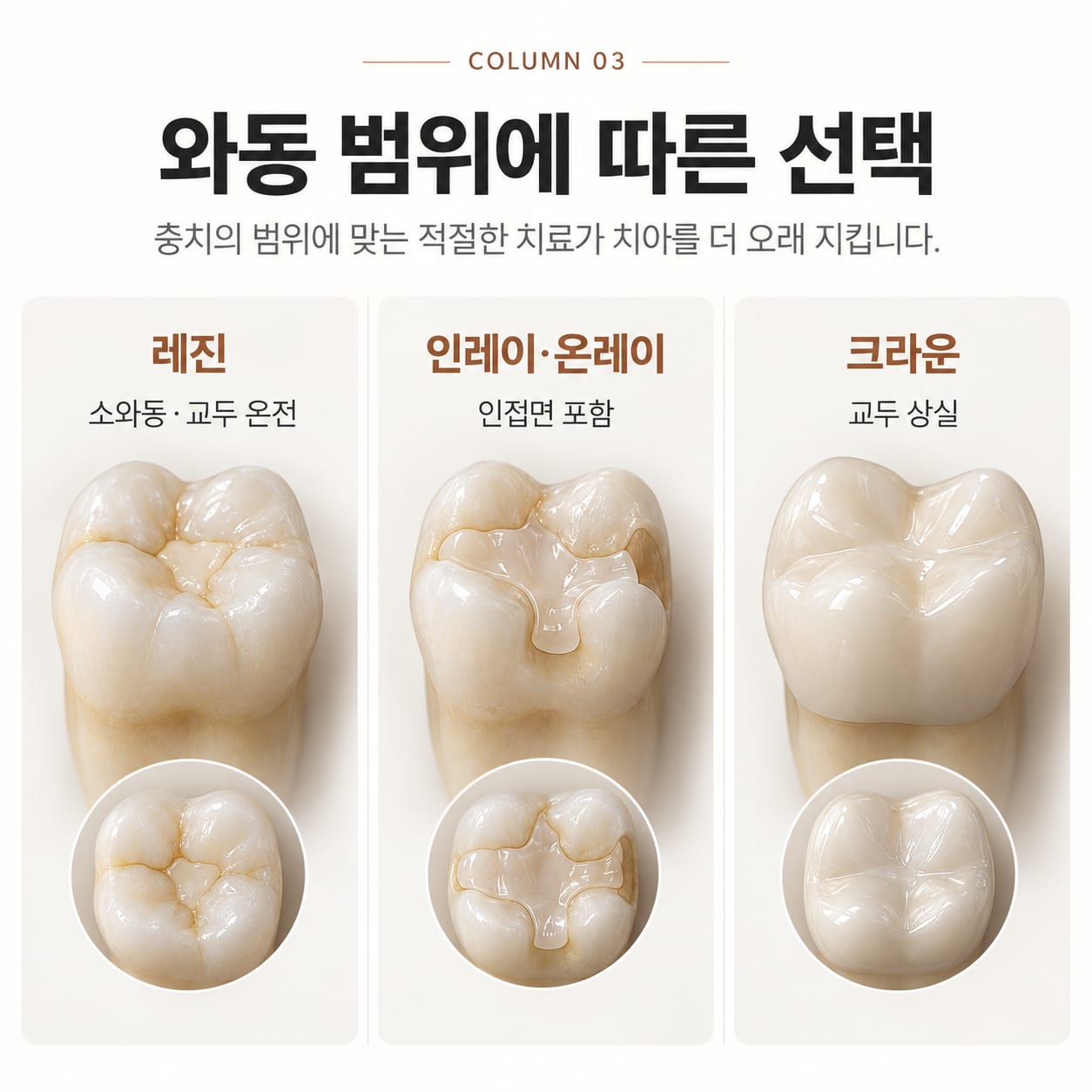 소와동·교두 온전은 레진, 인접면 포함은 인레이·온레이, 교두 상실은 크라운으로 나뉘는 비교 그림