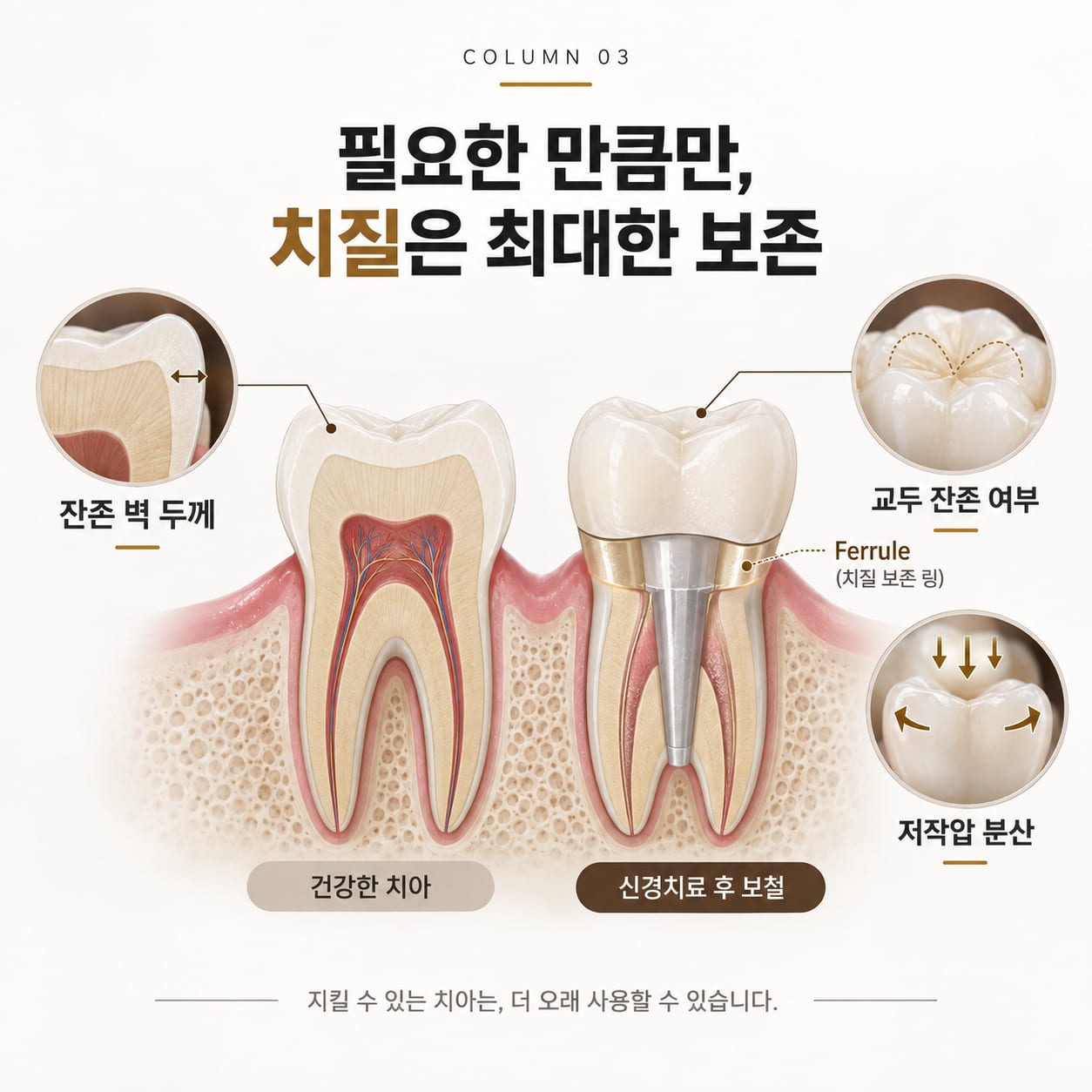 잔존 벽 두께와 교두 잔존 여부, 근관치료 후 보철의 페룰과 저작압 분산을 보여 주는 그림