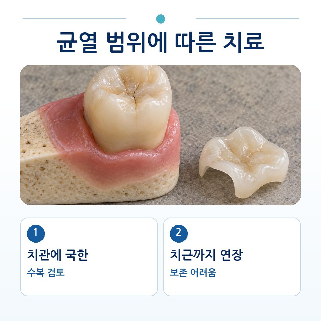치관에 국한된 균열의 수복과 치근까지 연장된 균열의 보존 곤란을 비교한 그림