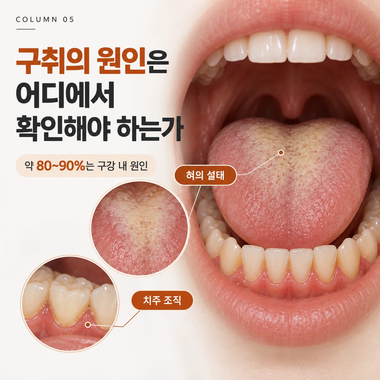 구취의 확인 부위인 혀의 설태와 치주 조직을 확대해 표시한 구강 사진