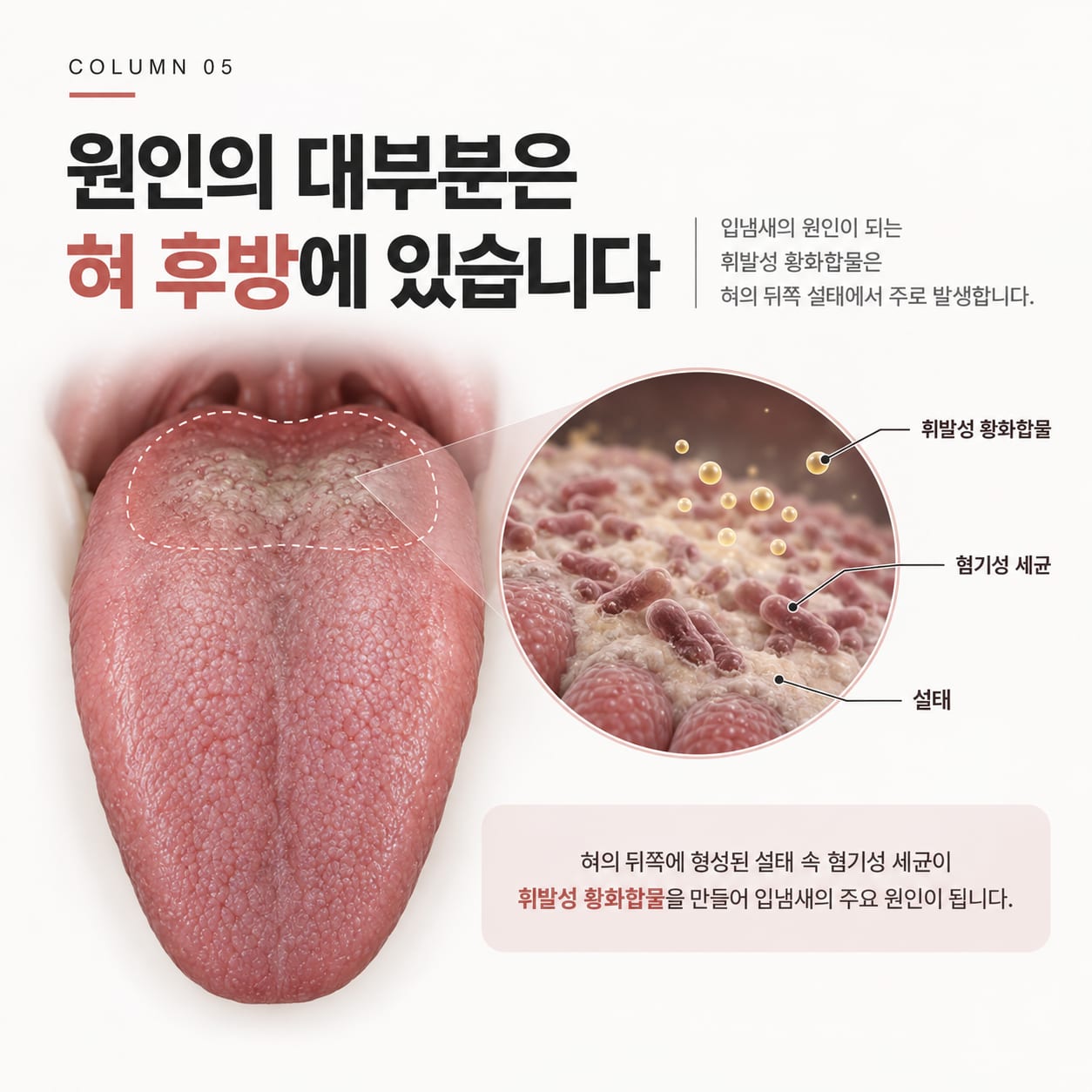 혀 후방 설태 속 혐기성 세균이 휘발성 황화합물을 만들어 내는 과정을 확대한 그림