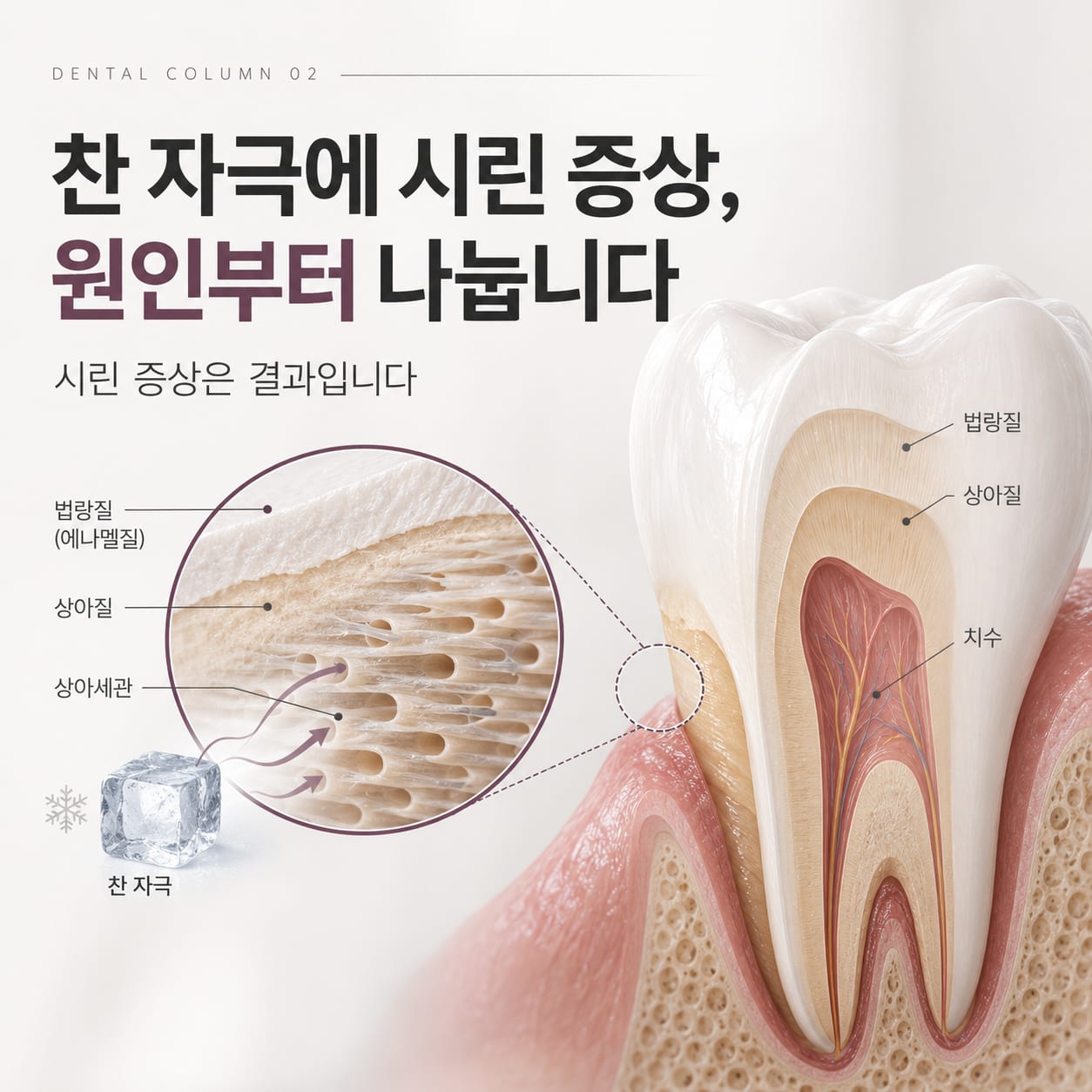 치아 단면에서 법랑질·상아질·치수의 구조와 상아세관이 찬 자극을 전달하는 경로를 보여 주는 그림