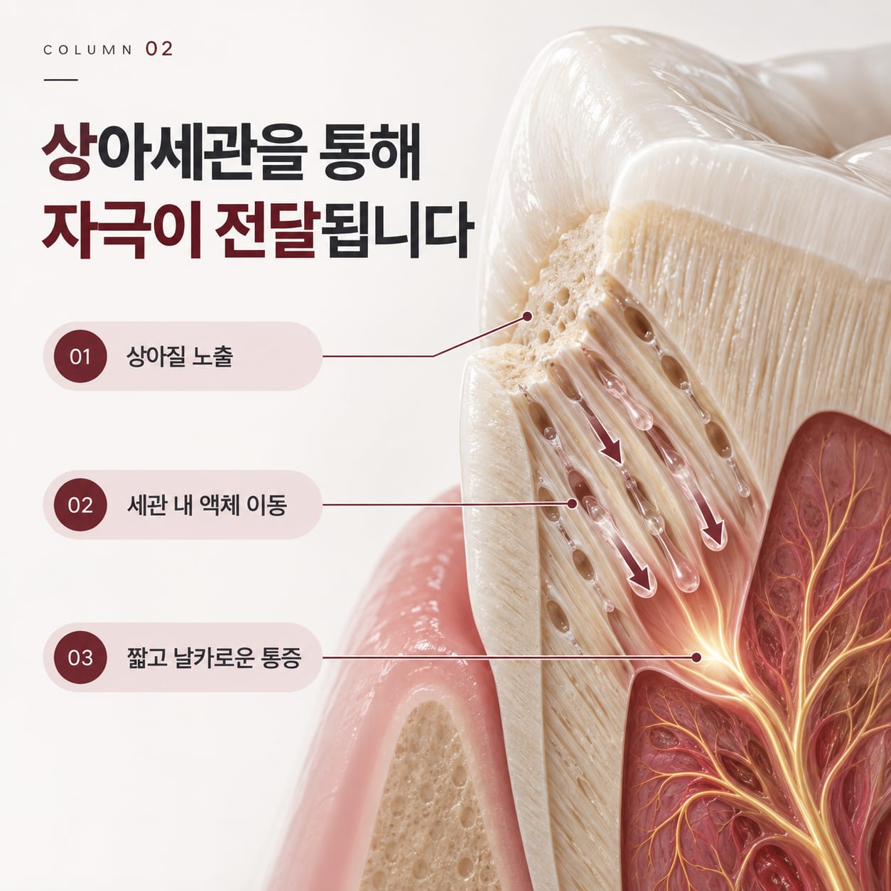 상아질 노출, 세관 내 액체 이동, 짧고 날카로운 통증으로 이어지는 3단계 그림
