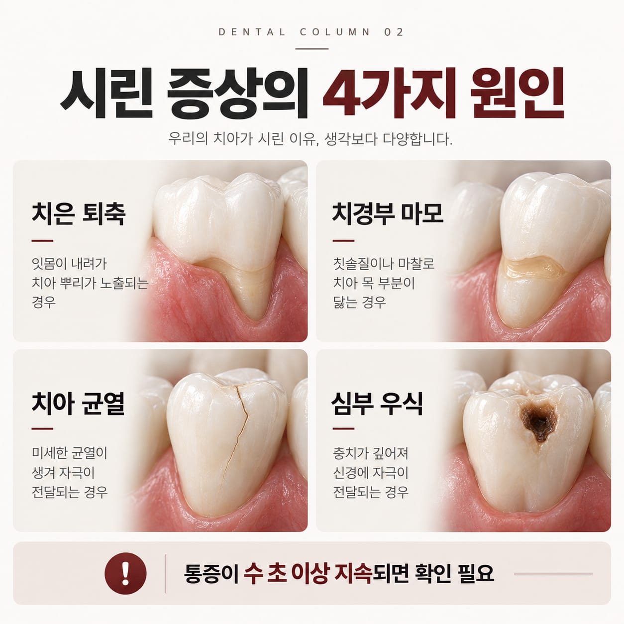 시린 증상의 네 가지 원인 — 치은 퇴축, 치경부 마모, 치아 균열, 심부 우식 비교 그림