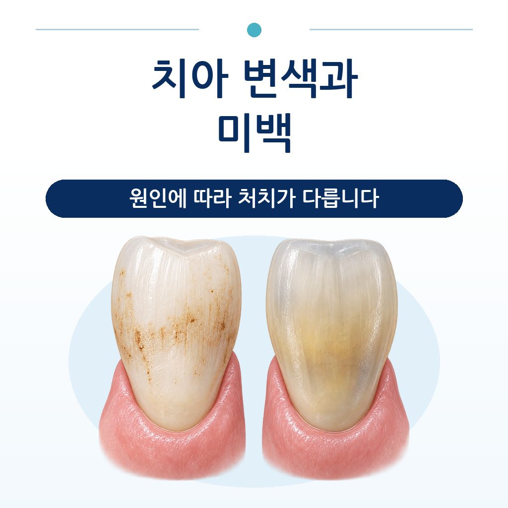표면에 색소가 침착된 치아와 치질 내부에서 색이 변한 치아를 나란히 비교한 그림