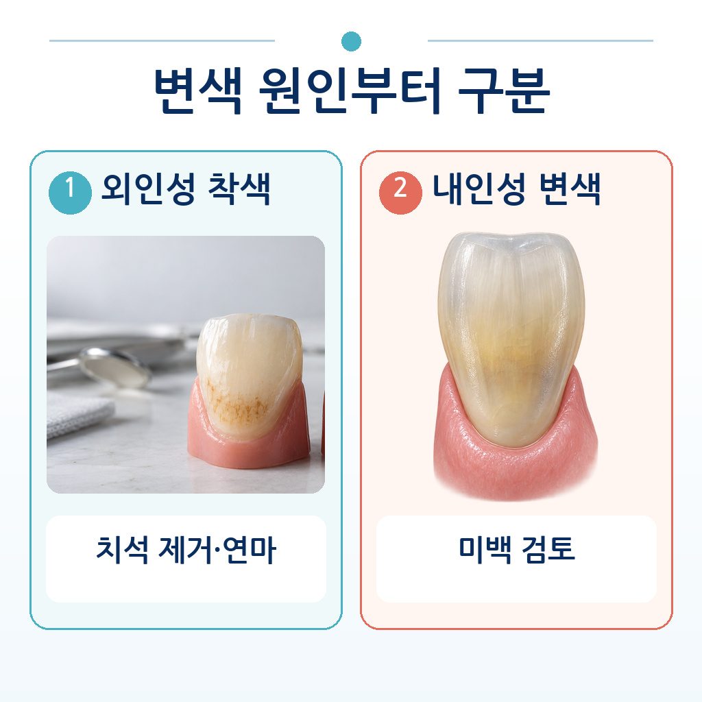 표면에 색소가 침착된 외인성 착색과 치질 내부에서 기인한 내인성 변색을 비교한 그림